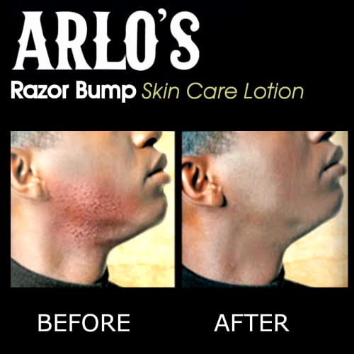 Arlo's Razor Bump Skin Care Lotion 6 oz - Palms Fashion Inc.
