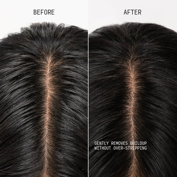 Before and after comparison of scalp showing reduced buildup and cleaner hair.
