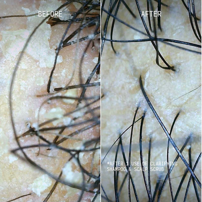 Before and after scalp comparison showing reduced buildup and clearer skin texture.