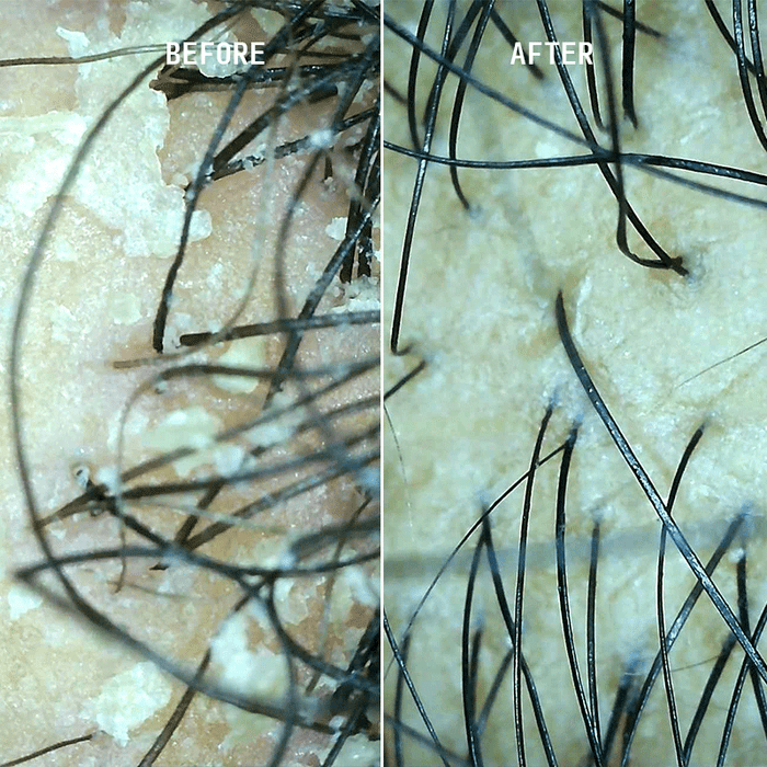 Microscopic before and after split image showing scalp flake and buildup removal after using Cécred Clarifying Shampoo & Scalp Scrub, revealing visibly cleaner scalp skin